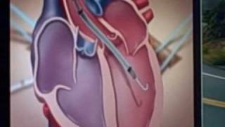 Impella 50 animation showing how it aids heart failure patients [upl. by Annissa933]