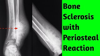 Bone sclerosis with periosteal reaction Differential Diagnosis [upl. by Taddeo]