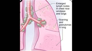 Sarcoidosis Noncaseating Granulomas [upl. by Karlotta880]