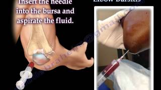 Aspiration Of Elbow Bursitis  Everything You Need To Know  Dr Nabil Ebraheim [upl. by Aja]