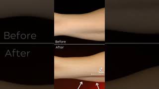 Arm fat Bingo Wing removal using coolsculpting shorts [upl. by Engeddi518]