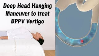 Deep Head Hanging Maneuver to Treat BPPV Vertigo [upl. by Matuag355]