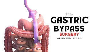 What is Gastric Bypass Surgery  TORe  Animated Video [upl. by Adiaros]