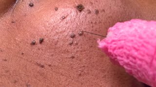 DPN Dermatosis Papulosa Nigra Removal [upl. by Atiuqat]