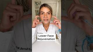 Lower Face Rejuvenation drbitafarrell botox fillers [upl. by Hermine798]