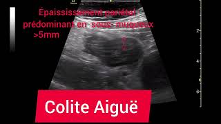 Colite Aiguë Ulcéreuse Hémorragique Colon Gauche Échographie [upl. by Collen]