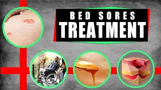 Bed Sores Treatment How to Treat Bed Sores at Home – Top 5 Remedies for Bed Sores [upl. by Shannah]