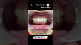 Teeth Straightening With Clear Aligners Treatment in Hyderabad  Aligners Braces  Smile Makeover [upl. by Nosneh]