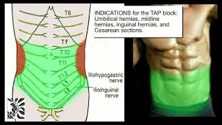 The UltrasoundGuided TAP Block [upl. by Nawrocki272]