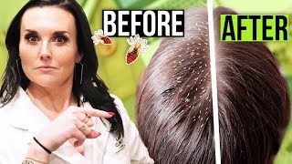 How to Get Rid of Lice FAST 1 Hour Lice Treatment [upl. by Natiha]