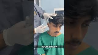 Bat Ear Correction under Local Anesthesia  Otoplasty in India  Before Surgery shorts [upl. by Mahon565]