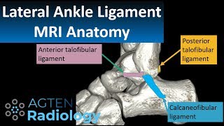 MRI Anatomy of lateral ankle ligaments [upl. by Ocisnarf]