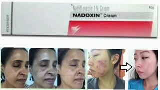 NADOXIN Cream Nadifloxacin 1 Cream [upl. by Manoff130]