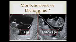 Monochorionic or dichorionic twins [upl. by Seugirdor]