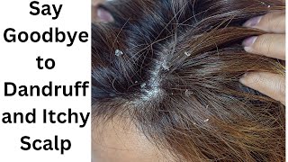 Effective Home Remedies for Dandruff and Itchy Scalp  Natural Solutions [upl. by Lamoree]