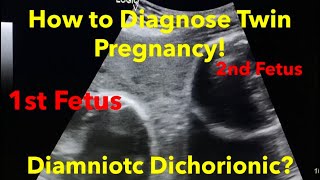 Twin Pregnancy  Diamniotic Dichorionic how to diagnose  easy steps [upl. by Eedrahs177]