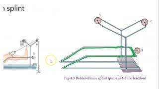 Orthopedics 045 bohler braun splint [upl. by Fafa]