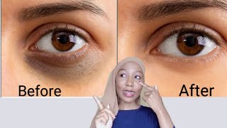 How to Get Rid of Dark Circles amp puffiness fast [upl. by Annawat788]