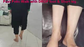 Video 1  Post Polio Paralysis  drop foot  limb length discrepancy [upl. by Eednahs363]