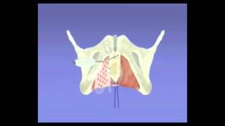 PROLAPSOS GENITAIS  Cirurgia de Prolapso com Tela Calistar [upl. by Elleined21]