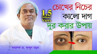 How To Remove Dark Circles  চোখের নিচের কালো দাগ দূর করার উপায়  Choker Nicher Kalo Dag Dur Kora [upl. by Mojgan]