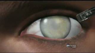 Medical Breakthrough Restoring Sight to the Blind [upl. by Lehcar]