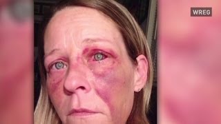 Woman posts abuse photos to help others [upl. by Naomi684]