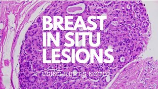 Breast In Situ Lesions Kurt’s Notes pathagonia [upl. by Doowrehs602]