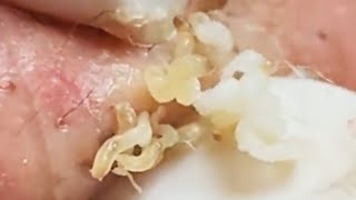 Blackheads Milia Big Cystic Acne Blackheads Extraction Whiteheads Removal Pimple Popping 2021 [upl. by Uis915]