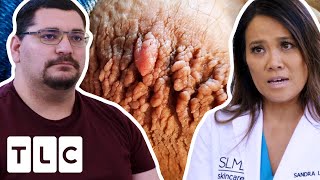 Rupturing Thigh Chafing Keeps Him From Fully Being Part Of His Family  Dr Pimple Popper [upl. by Ecnedurp]