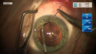 Pupil Cerclage with Multifocal Toric IOL [upl. by Calesta]