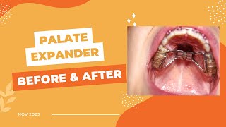 Palate Expander Installation Before and After [upl. by Glenden]