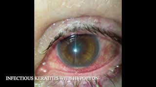 INFECTIOUS KERATITIS WITH HYPOPYON [upl. by Lainad]