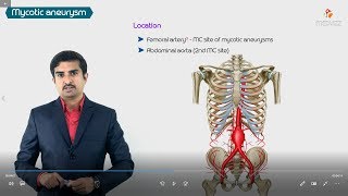 Mycotic Infected Aneurysms  Highyield Usmle step 1 pathology [upl. by Forward]