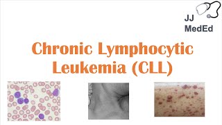 Chronic Lymphocytic Leukemia CLL Symptoms ex Skin Blisters Diagnosis and Treatment Vit D [upl. by Latton]