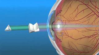 Multifocal Lens IOL [upl. by Marlene]