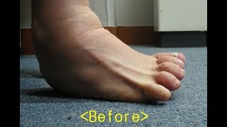 Polio  Rt foot cavovarus claw toes equinus surgery by Dr Ahn [upl. by Ocko114]