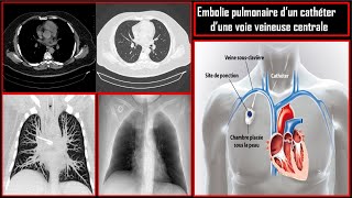 Dossier radiologique 1 Embolie pulmonaire dun cathéter veineux central [upl. by Anairotciv]