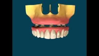 Protocolo sobre Implantes Dentários [upl. by Annayt]