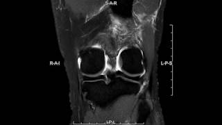 Chondral injury of the knee  complete MRI examination [upl. by Clementas]