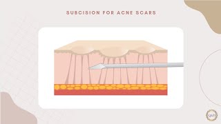 Subcision Treatment for Deep Acne Scars [upl. by Dwinnell]