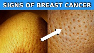 15 Warning Signs Of Breast Cancer You Shouldnt Ignore [upl. by Phonsa]