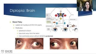 Lecture Prescribing Prism for Diplopia in NeuroOphthalmic Disorders Part II [upl. by Whall]