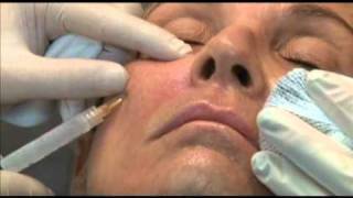 Sculptra Injection Technique  Dr JR Montes [upl. by Yrotciv]