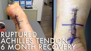 Ruptured Achilles Tendon Recovery  Tom Goss [upl. by Rahal]