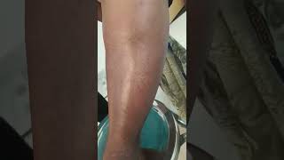 quotConsequences of Untreated Leg Cellulitis A Warning Videoquot [upl. by Jumbala228]