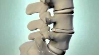 Herniated Disc  DePuy Videos [upl. by Leirol673]