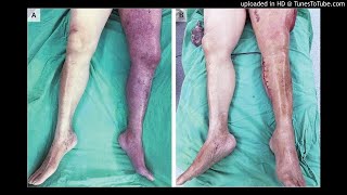 Phlegmasia Cerulea Dolens with Compartment Syndrome [upl. by Sinclare]