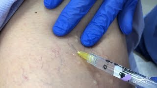 Sclerotherapy Leg Vein Treatment  Glycerin vs Asclera [upl. by Aihsiek]