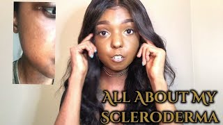 Living With Scleroderma  All about my scleroderma [upl. by Dhruv683]